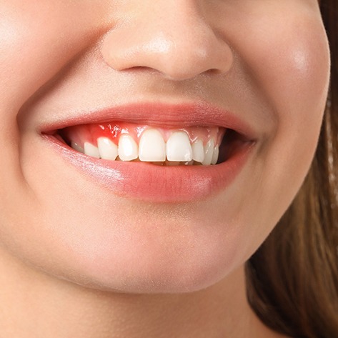 Close-up of smile with signs of gum disease in West Loop Chicago