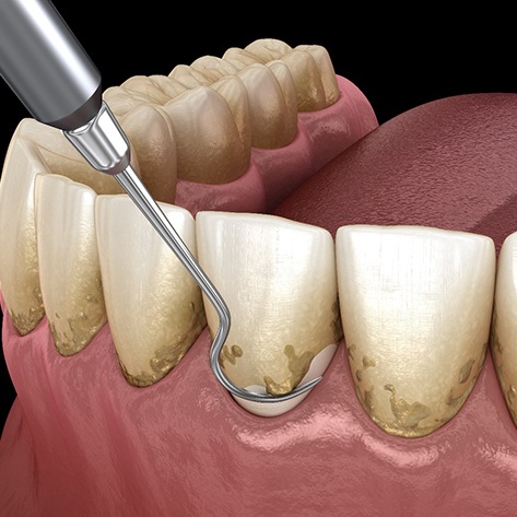 Illustration of scaling and root planing for gum disease treatment in West Loop Chicago