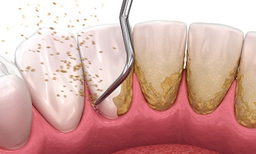 Scaling and root planing performed on back of teeth