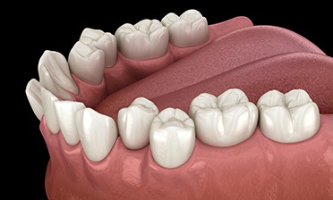 Illustration of crooked teeth