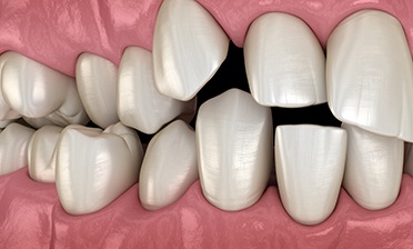 Illustration of spaced out teeth