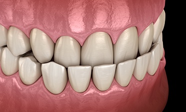 Illustration of an underbite