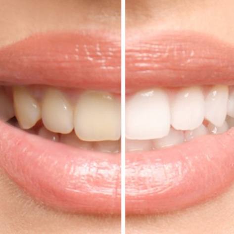 a before and after image of a whitened smile