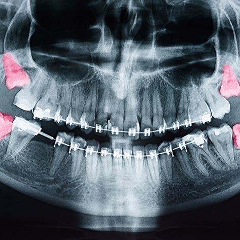 A dental x-ray highlighting a patient’s wisdom teeth