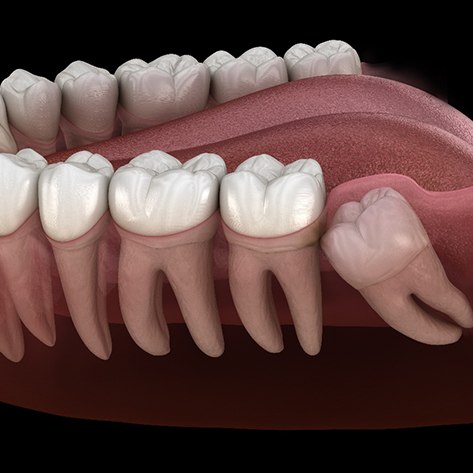 A 3D illustration of an impacted wisdom tooth