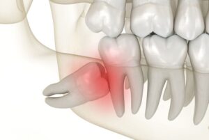 Illustration of fully impacted wisdom tooth
