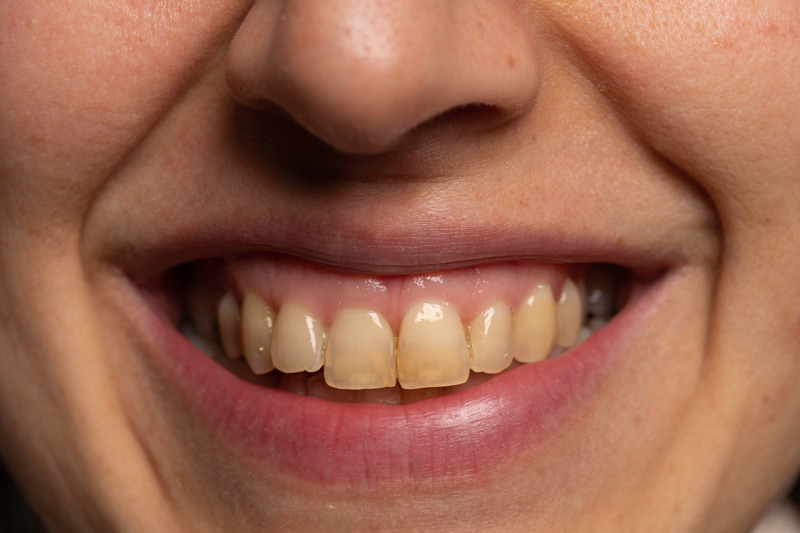 Patient smiling with tooth discoloration